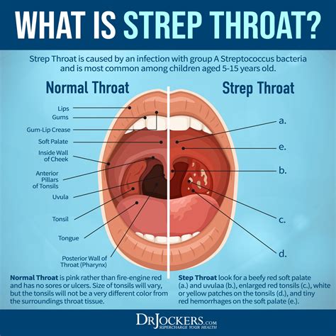 Strep throat: Causes, diagnosis, and treatments .